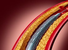 India Coronary Stents Market to Experience High Growth Driven by Increasing Demand and Technological Advancements