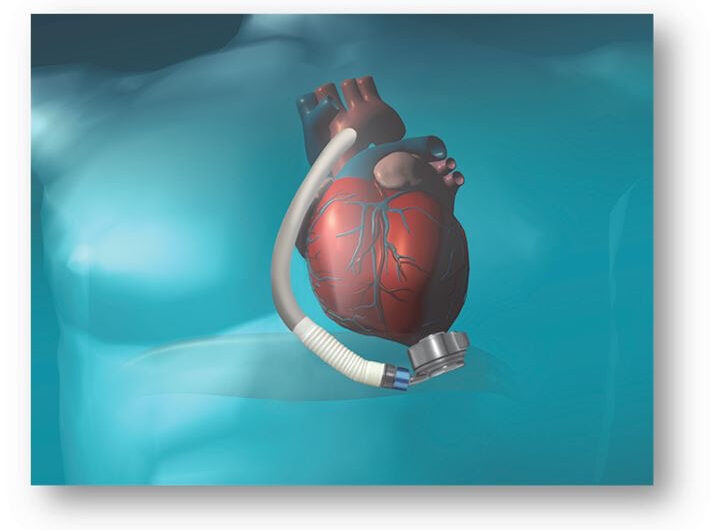 Future Prospects: Increasing Incidences of Cardiovascular Diseases to Drive Growth of the Cardiac Assist Devices Market