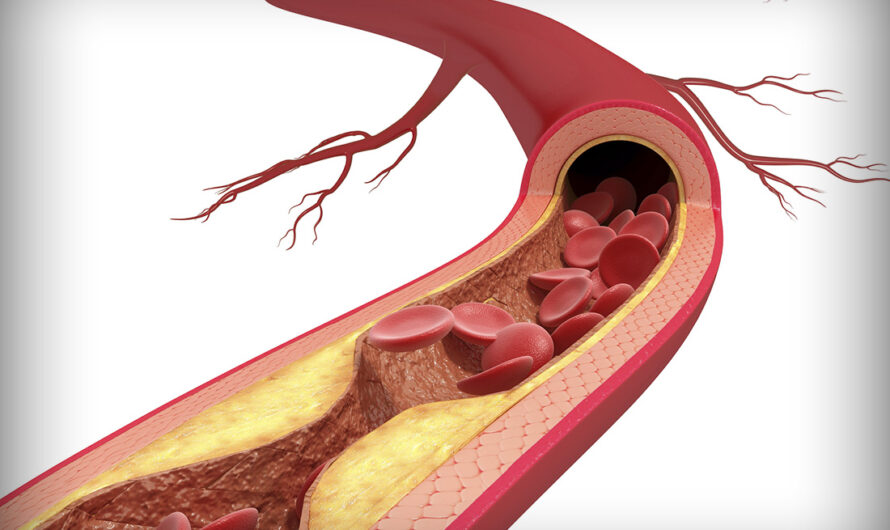 Excessive Protein Consumption Linked to Increased Atherosclerosis Risk
