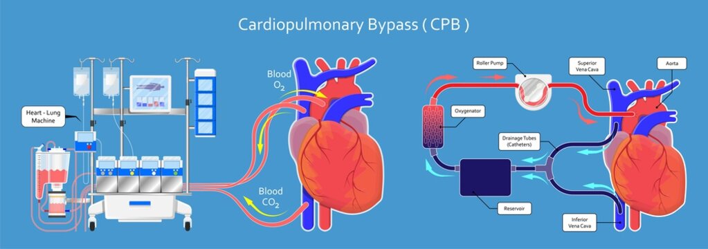 Cardiopulmonary Bypass Equipment Market