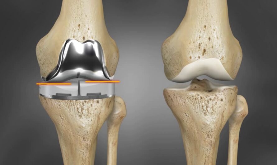 Collagen Meniscus Implant Market Is Estimated To Witness High Growth Owing To Advancement In Regenerative Medicine