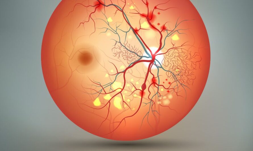 Diabetic Retinopathy Market is projected to propel by increasing adoption of artificial intelligence and deep learning technologies