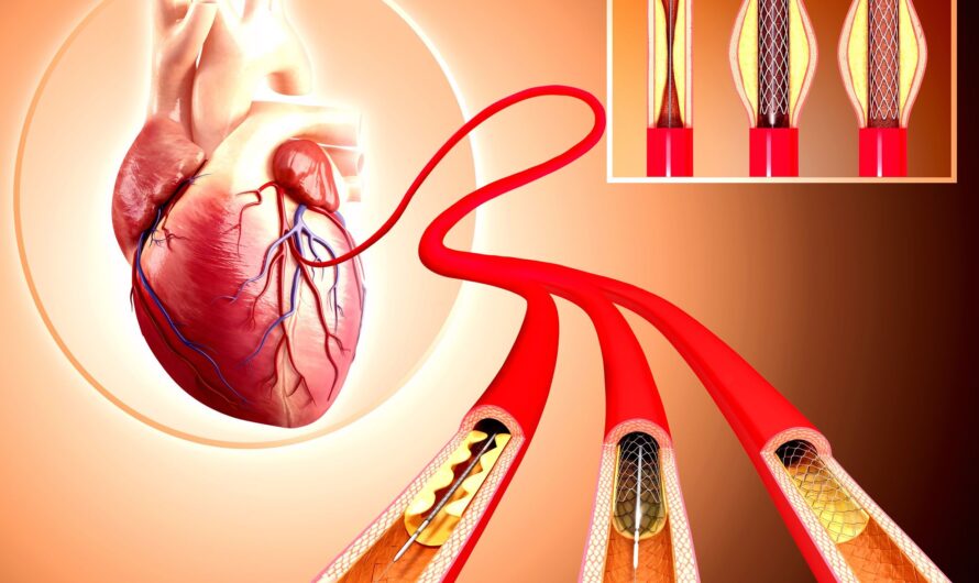 Insights into the Indian Coronary Stents Growth Trends, Product Type Dynamics, Regional Demand Analysis, Domestic Manufacturing Trends