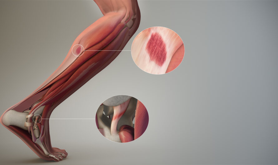Soft Tissue Repair: Meeting the Challenges of Healing Injured Muscles, Tendons and Ligaments