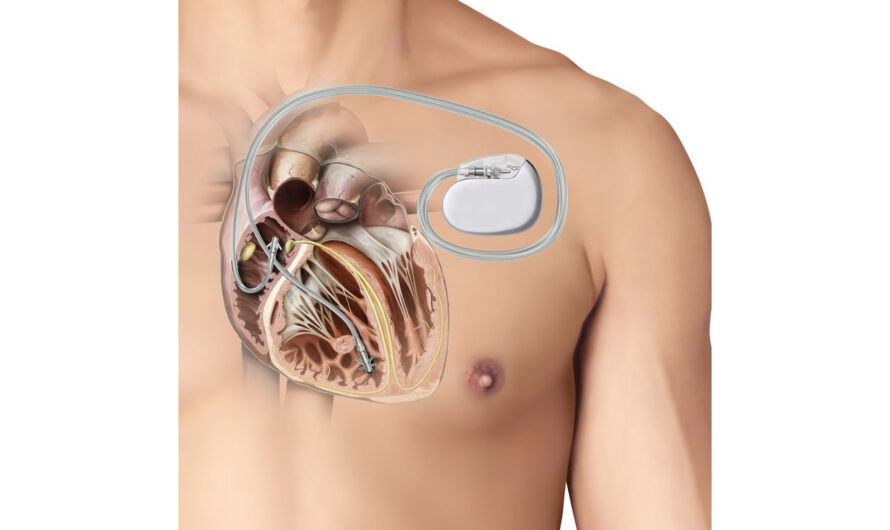 Cardiac Pacemakers In Brazil: Brazil Has Become One Of The Top Countries