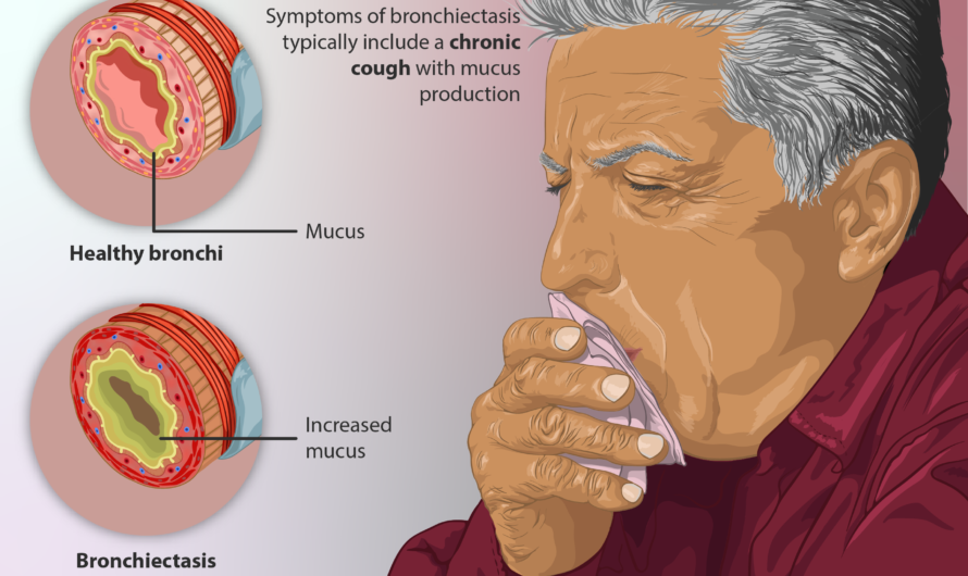 Bronchiectasis Drugs: Available Treatment Options