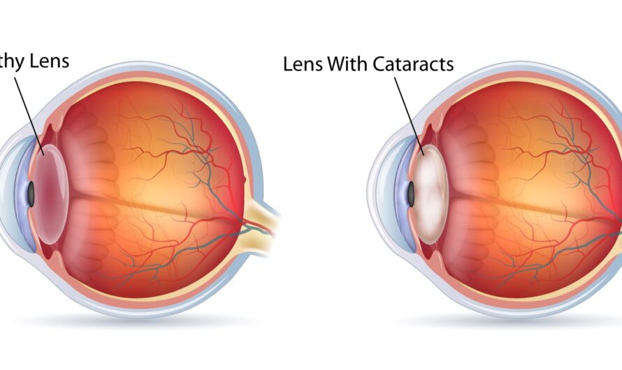 Understanding Diabetic Retinopathy Retinopathy Is A Medical Condition In Which Damage Occurs To The Retina