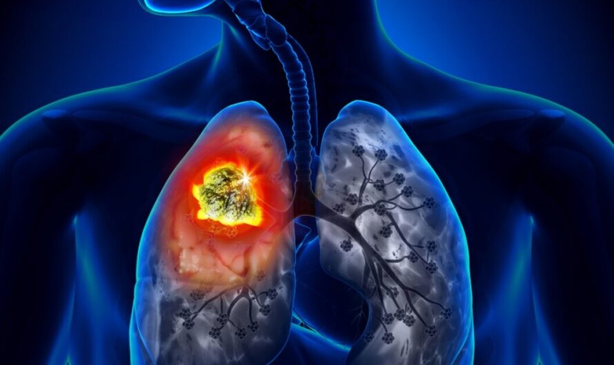 Lung Cancer Diagnostic And Screening Methods Some Common Symptoms Of Lung Cancer