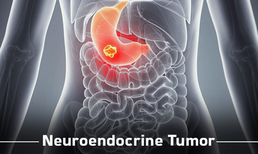 Neuroendocrine Tumor Treatment Market Is Estimated To Witness High Growth Owing To Advancements In Targeted Therapy