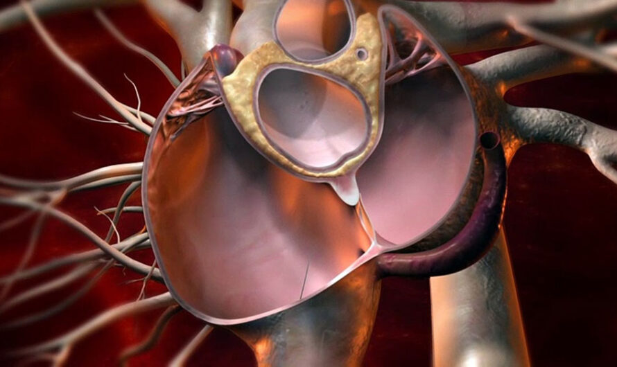 Patent Foramen Ovale (PFO) Closure Devices  Linked To An Increased Risk Of Stroke Or Migraine Headaches