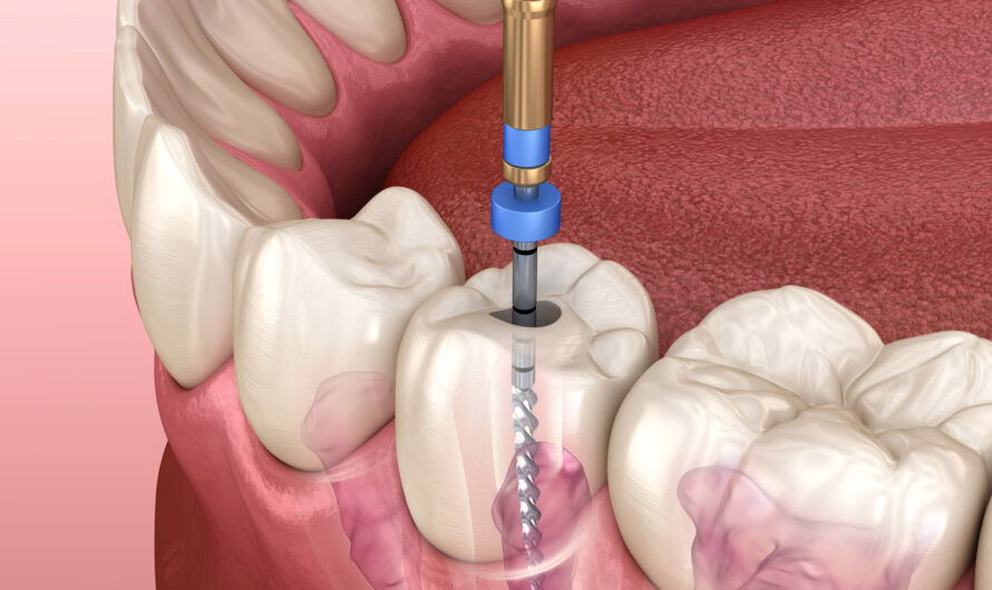 Global Root Canal Files Market is Estimated to Witness High Growth Owing to Advancements in Nickel-Titanium Technology